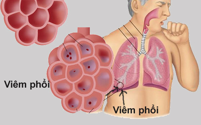 Viêm phổi do vi-rút - Hình ảnh minh họa