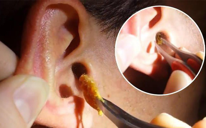 Viêm màng nhĩ - Hình ảnh minh họa