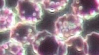 Viêm phổi do Mycoplasma pneumonia (MP) - Hình ảnh minh họa