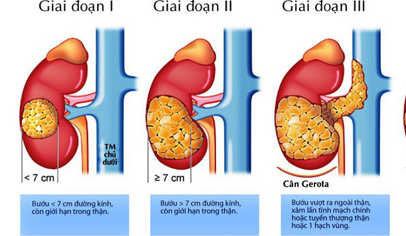 Wilms tumor - Hình ảnh minh họa