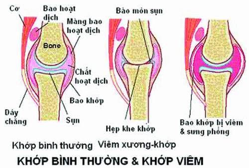 Viêm khớp thiếu niên - Hình ảnh minh họa