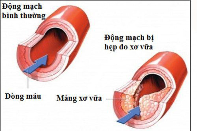 Xơ vữa động mạch - Hình ảnh minh họa