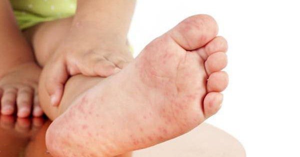 Bị sởi phải kiêng nước, kiêng gió đúng hay sai? - ảnh 1