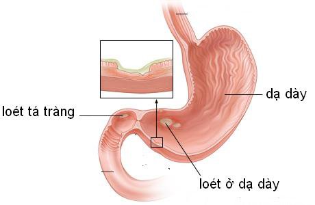 Đau dạ dày ăn gì để nhanh khỏi bệnh? - ảnh 1