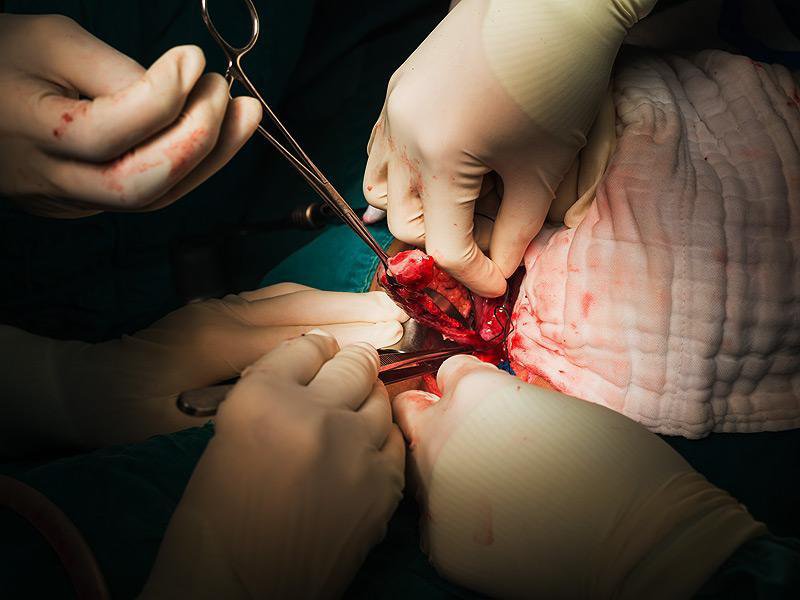 Viêm ruột thừa cấp những điều cần biết - ảnh 2