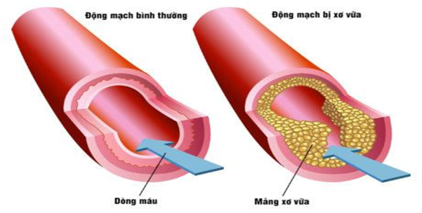 Nhồi máu cơ tim cấp là gì? Nguyên nhân và Triệu chứng nhận biết - ảnh 1
