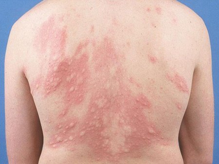 Một số bệnh dị ứng hay gặp ở trẻ em - ảnh 1