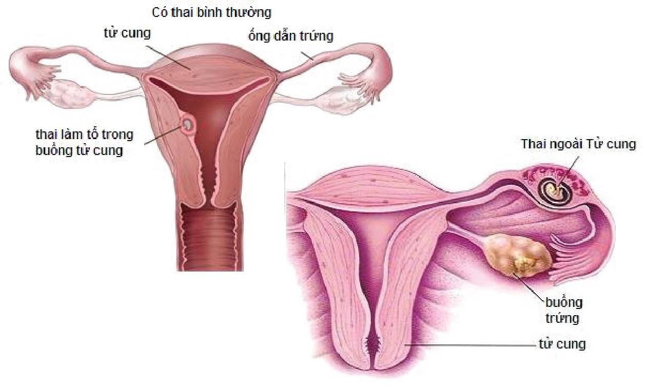 Viêm nhiễm âm đạo là nguyên nhân hàng đầu gây tắc ống dẫn trứng - ảnh 1