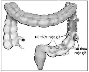 Diverticulitis - Hình ảnh minh họa