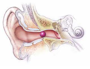 Dị vật trong tai - Hình ảnh minh họa