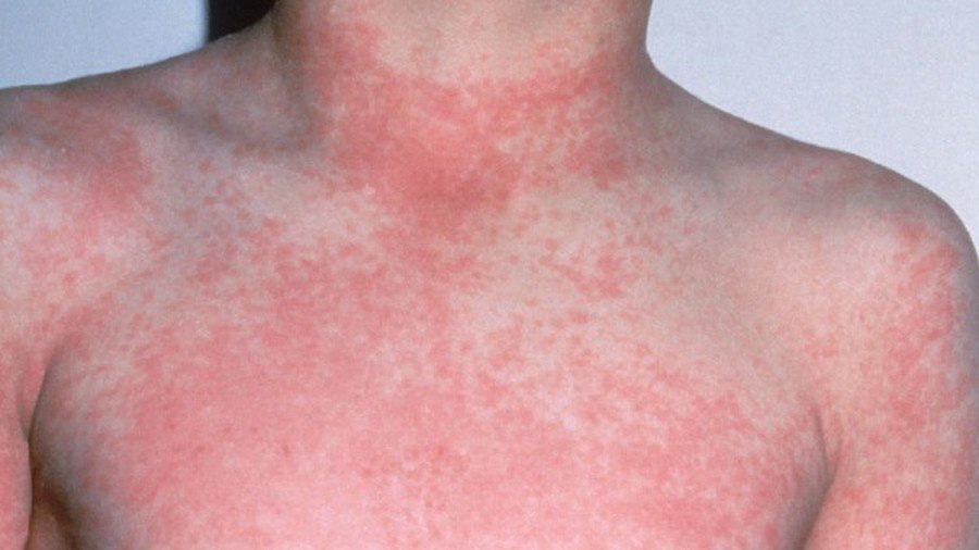 Dấu hiệu và biến chứng của sốt virus ở người lớn - ảnh 1