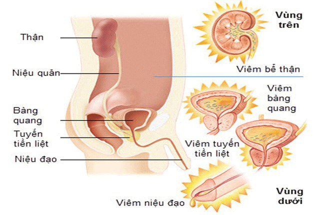 Dấu hiệu và cách chữa bệnh viêm đường tiết niệu ở nam giới - ảnh 2