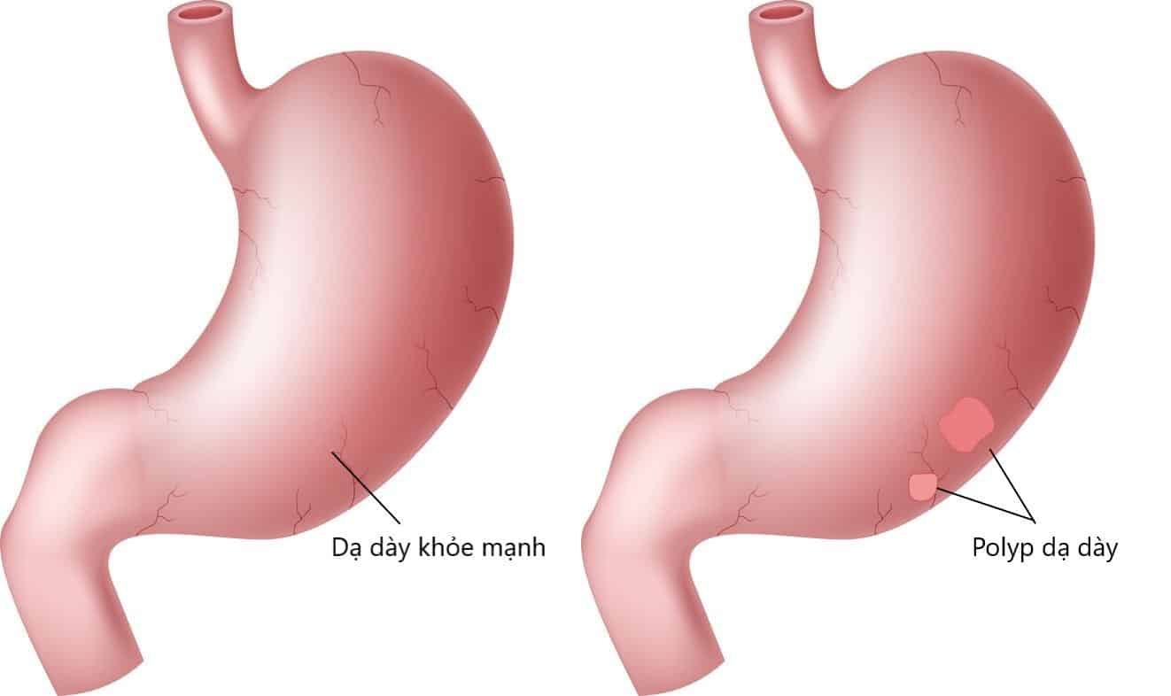 Gastric polyp - Hình ảnh minh họa