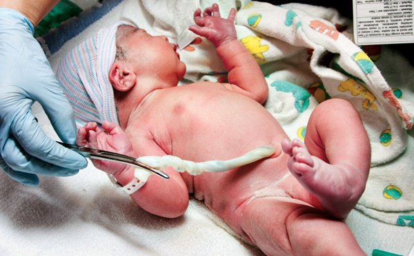 Máu cuống rốn được lấy vào thời điểm nào sau khi sinh? - ảnh 1