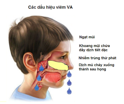 Viêm VA cấp tính và viêm VA mạn tính có biểu hiện như thế nào? - ảnh 1