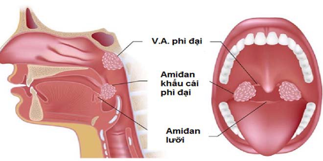 Khi nào nên nạo VA và cắt amidan cho trẻ? - ảnh 1