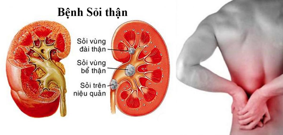 Sỏi thận hình thành như thế nào? - ảnh 1