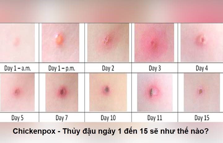 Bệnh thủy đậu: Nguyên nhân, triệu chứng, biến chứng và cách điều trị - ảnh 1