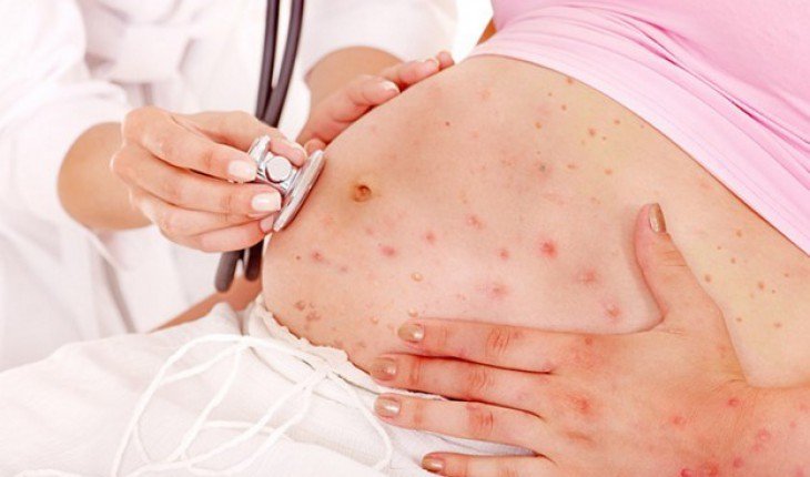 Bệnh thủy đậu: Nguyên nhân, triệu chứng, biến chứng và cách điều trị - ảnh 2