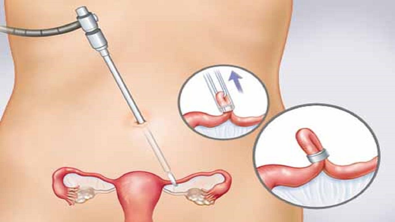 Thắt ống dẫn trứng có ảnh hưởng đến chu kỳ kinh nguyệt không? - ảnh 2