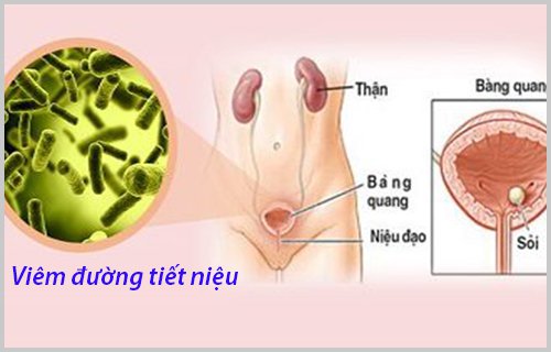 Viêm đường tiết niệu là bệnh gì và có nguy hiểm không? - ảnh 1