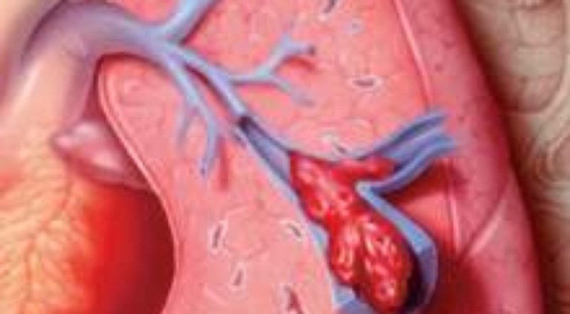 Thuyên tắc động mạch phổi - Hình ảnh minh họa