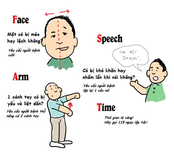10 dấu hiệu tai biến ai cũng cần biết để xử lý kịp thời - ảnh 2