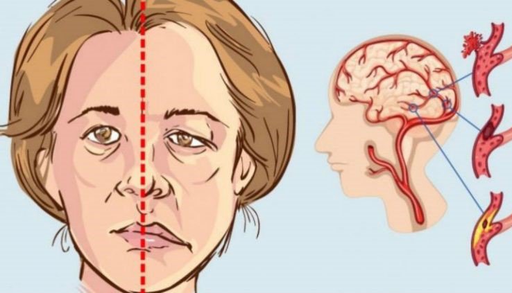 10 dấu hiệu tai biến ai cũng cần biết để xử lý kịp thời - ảnh 1