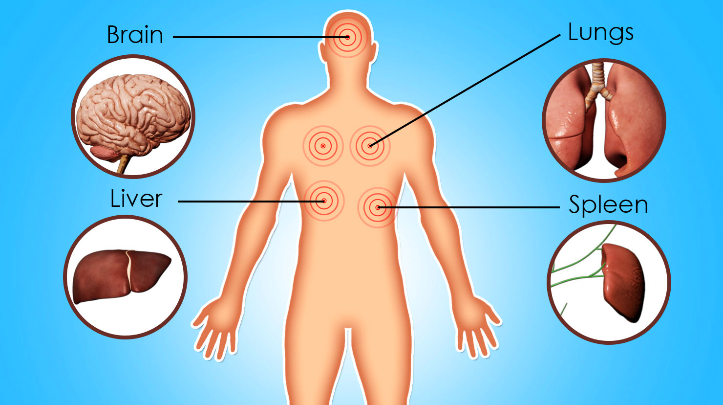 Gaucher - Hình ảnh minh họa