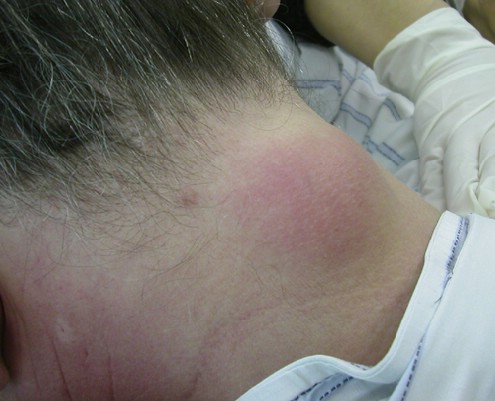 U nang bã nhờn - Hình ảnh minh họa