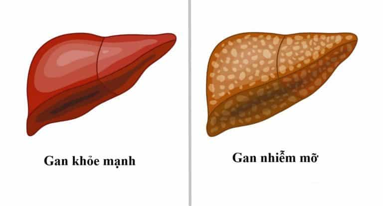 Gan nhiễm mỡ - Hình ảnh minh họa