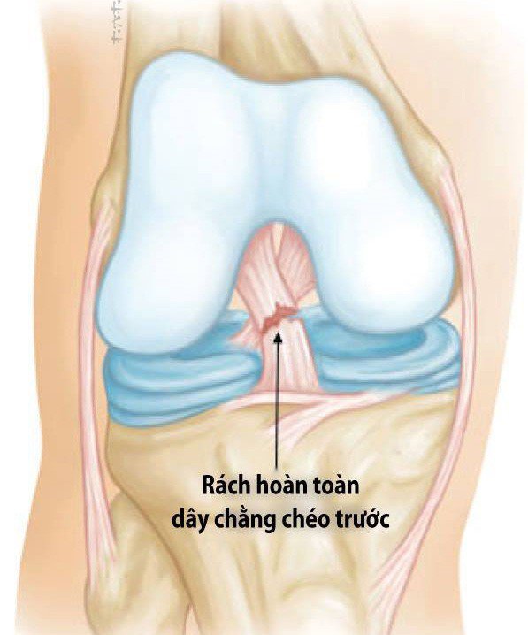 Bị đứt dây chằng chéo khớp gối bao lâu có thể chơi thể thao trở lại? - ảnh 1