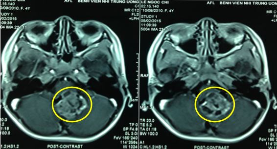 U sao bào - Hình ảnh minh họa