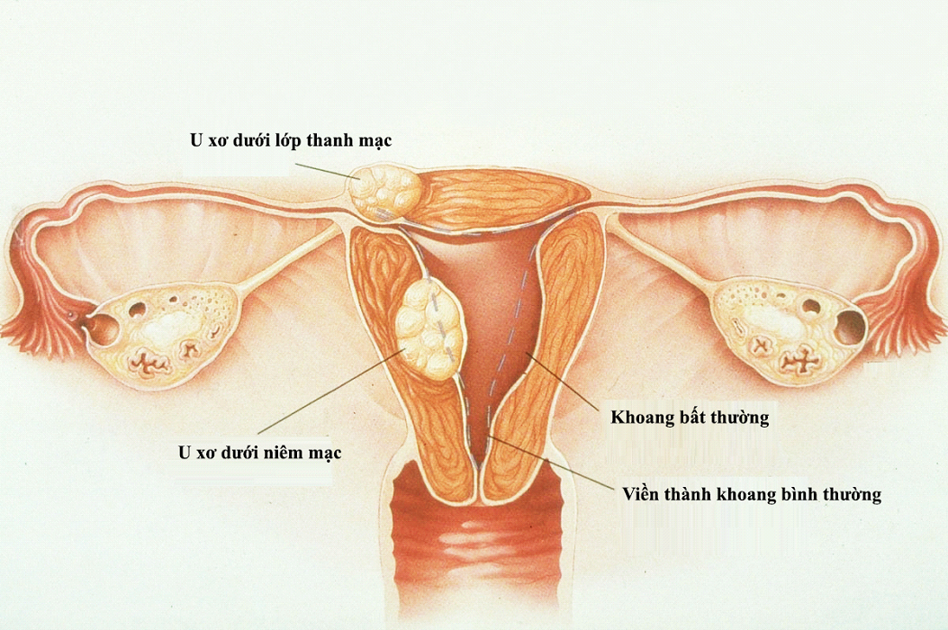 mổ bóc tách u xơ tử cung