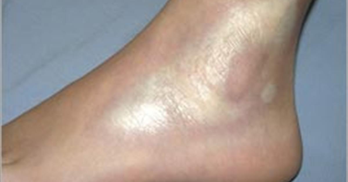 Morphea - Hình ảnh minh họa