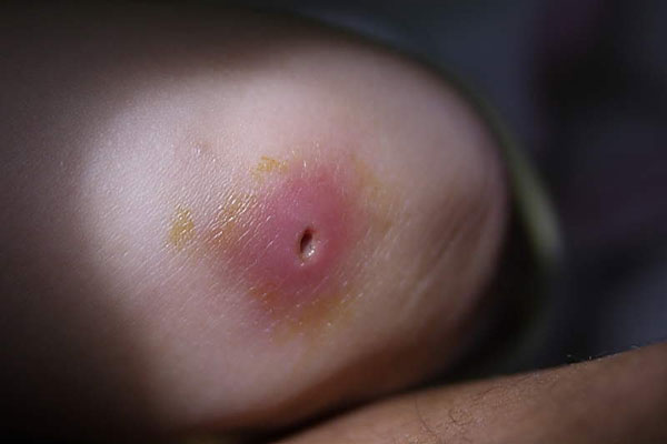 Nhọt - Hình ảnh minh họa