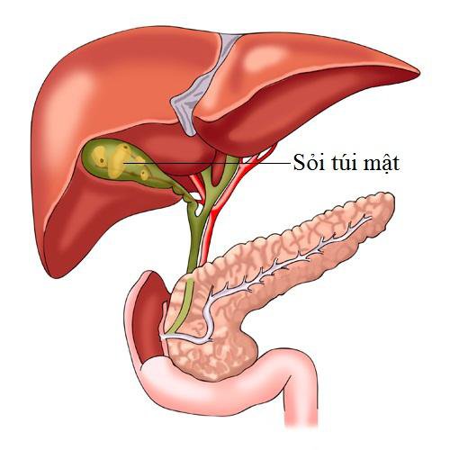 Sỏi túi mật: Khi nào cần phẫu thuật? - ảnh 1