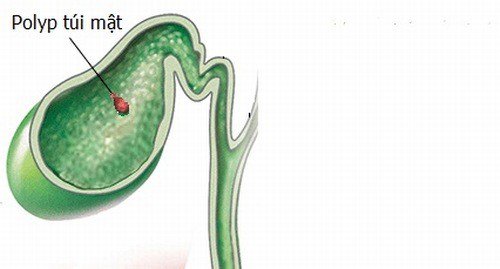 Polyp túi mật là bệnh gì, Triệu chứng và có cần phải điều trị không? - ảnh 1