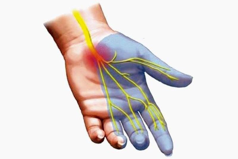Triệu chứng của viêm bao gân cổ tay - ảnh 2