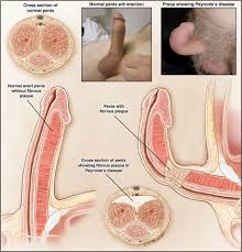 Peyronie - Hình ảnh minh họa