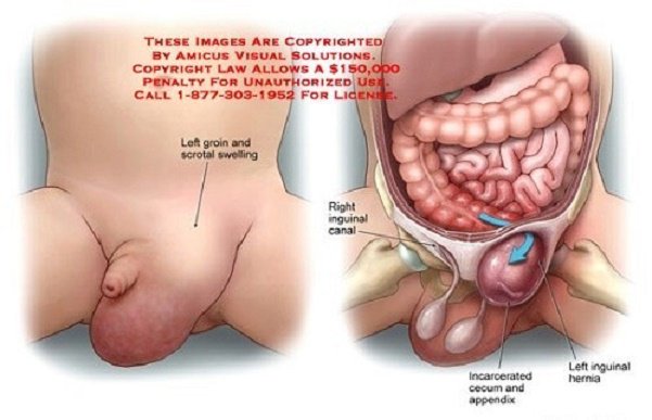 Thoát vị bẹn ở người lớn có nguy hiểm không? - ảnh 1