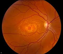 Stargardt - Hình ảnh minh họa