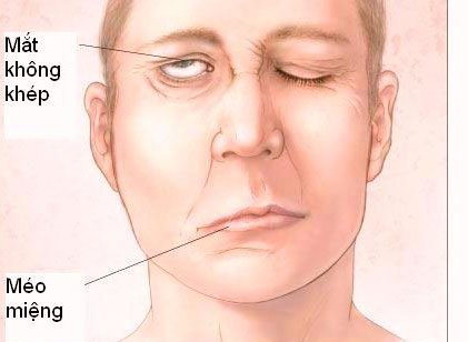 Liệt dây thần kinh số VII (liệt mặt) có nguy hiểm không? - ảnh 1