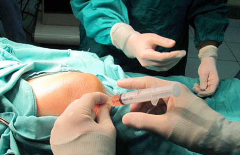Điều trị rách sụn chêm bằng huyết tương giàu tiểu cầu (PRP) - ảnh 4