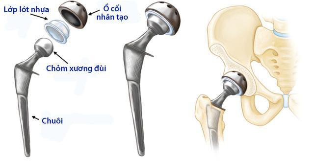 Thay khớp háng - Giải pháp tối ưu cho người bị tiêu chỏm xương đùi nặng - ảnh 2