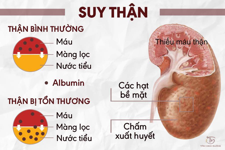 Ý nghĩa chỉ số xét nghiệm creatinine trong chẩn đoán suy thận - ảnh 1