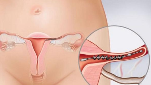 Viêm ống dẫn trứng: Nguyên nhân, triệu chứng, biến chứng và cách điều trị - ảnh 2