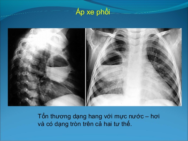 Áp xe phổi - Hình ảnh minh họa