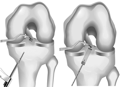Có những kỹ thuật nào để tái tạo dây chằng chéo sau chấn thương gối - ảnh 4