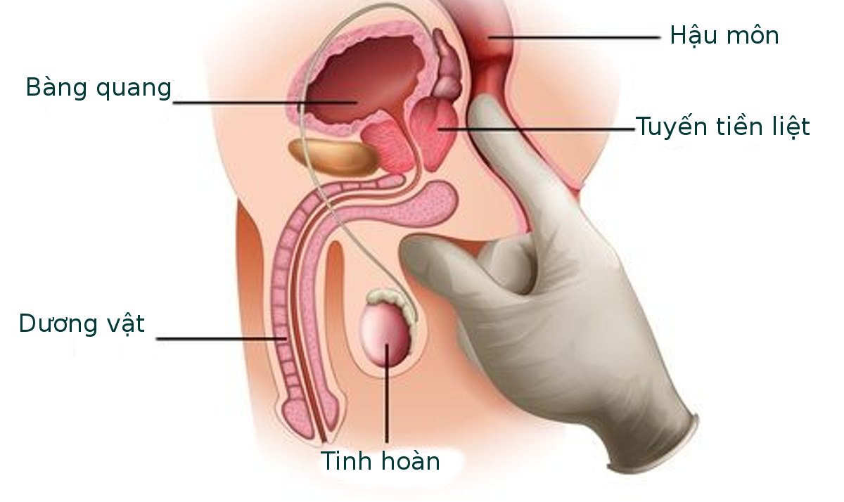Các triệu chứng ung thư tuyến tiền liệt giai đoạn cuối - ảnh 1